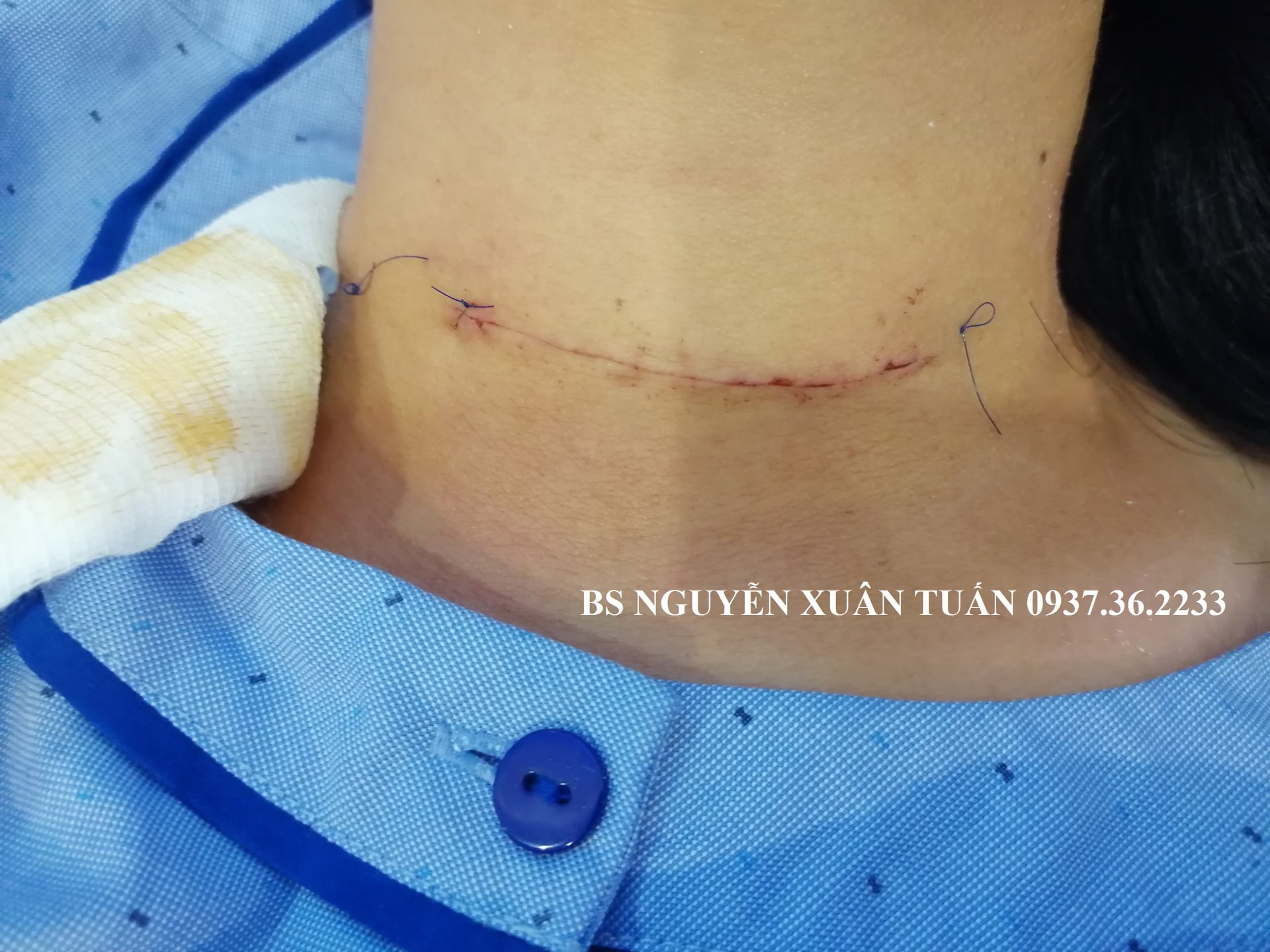 CHĂM SÓC VẾT MỔ TUYẾN GIÁP